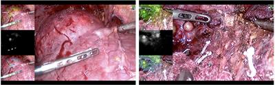 Application Effect of ICG Fluorescence Real-Time Imaging Technology in Laparoscopic Hepatectomy